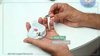 Tooth Replacement For Back Teeth Without Dental Implants! കുറഞ്ഞ ചിലവിൽ എങ്ങനെ പല്ലുവയ്ക്കാം?