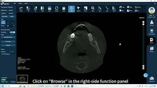 FinScan F350 Reconstruction to Remove Artifacts