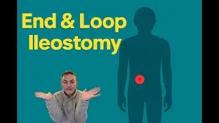 Loop vs End Ileostomy &ndash; What&rsquo;s the Difference Explained Simply