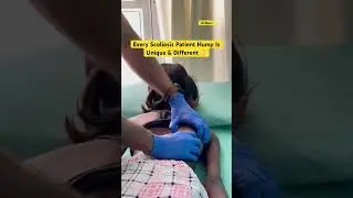 Big Rib Hump From Scoliosis treatment by DrRavi #scoliosistreatment #scoliosiswarrior #chiropractic