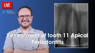 🔴 Retreatment of tooth 11 Apical Periodontitis