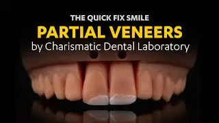 Partial Veneers by Charismatic Dental Laboratory