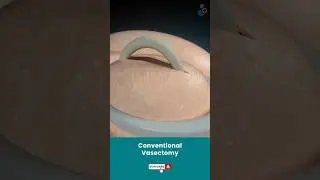 Conventional Vasectomy Surgery ↪ 3D Medical Animation #Shorts #Vasectomy #ConventionalVasectomy