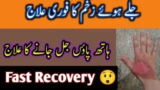 Jale hue jism ka ilaj ( fast Recovery) by fatima