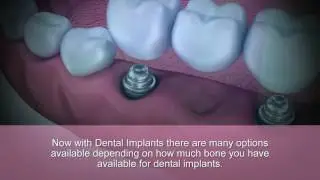 Implants Over Dentures in Brooklyn | BrightSmileDesign.com
