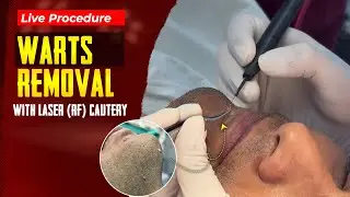 Warts Removal With Laser (RF Cautery) | Safe and Effective | Skin Tag Treatment at Skinroots