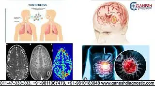 MR Spectroscopy Scan - Test Purpose, Preparation & Procedure | Ganesh Diagnostic