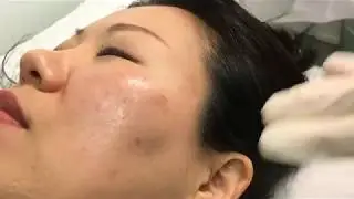 Brown Spot  Removal with Electrodessication