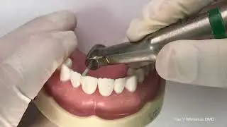 Anterior partial coverage indirect bonded restoration preparation workflow (Dr. Yair Whiteman)