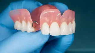 المحاضرة 11 الجزء الثاني بروس مرحلة ثالثة Types of clasps assemblies