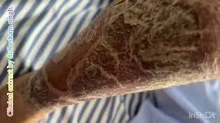 Plaque Psoriasis With Psoriatic Nail Changes