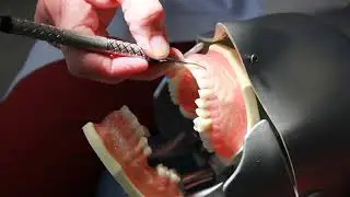Calculus Removal Strokes Subgingival Calculus Deposits