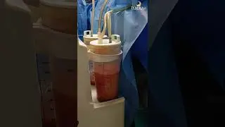 Liposuction Treatment (Who Needs It?)