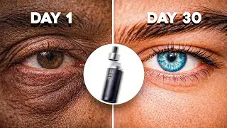 Fix Your Dark Circles & Eye Bags PERMANENTLY (NO BS)