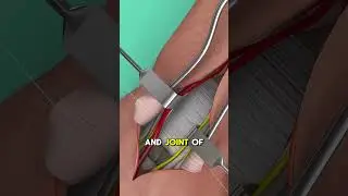 Операция по тотальному сращению запястья #3danimation#Wristfusion#wristsprain