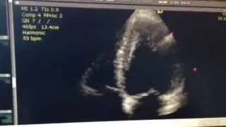 Your Heart on Stem Cells!