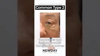 Ectropion &ndash; The Most Common Lower Eyelid Complication (Type ②) #PlasticSurgeryInfo #MedicalTips
