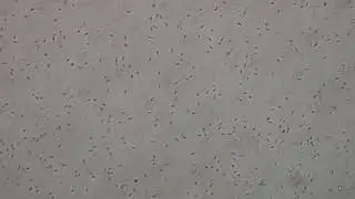 Male Factor Infertility