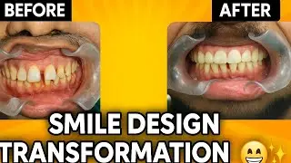 Smile Design with Zirconia #smiletransformation