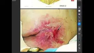 Surgery Wounds, Tissue repair and Scars Part 2