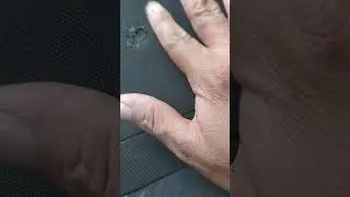 tapar quemadura de cigarro