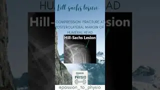 What is Hill sachs lesion? #anatomy #orthopedicinsights #pteducation #shoulderhealth