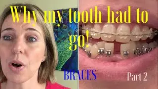Tooth extraction, bottom braces for 11 weeks, update part 2