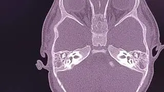Mastoid and middle ear opacification in children. What Radiologist needs to know.