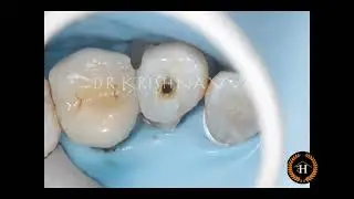 Canal projection for badly mutilated teeth, reinforcement & pre endo build up
