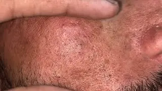 sac be spa blackheads elderly | sac be spa men age blackheads new 2026 | sac dep spa face scrub #400