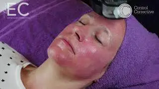 Control Corrective DERMAL FLASH FACIAL on the Esthetician Connection
