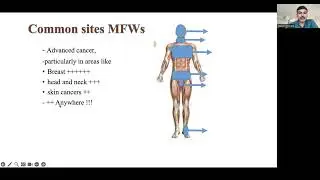 TIPS-ECHO Season 195 FCPN 30: Session 11|Wound Management 2- Fungating Ulcer|Br Sachin Dwivedi