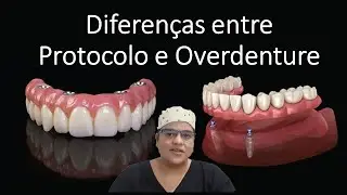 Diferen&ccedil;as entre dentadura fixa e remov&iacute;vel sobre implantes | Dra Bianca Rosa | Cl&iacute;nica Bianca Rosa