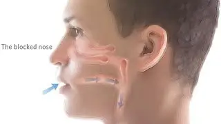 ACUPUNCTURE TREATMENT FOR BLOCKED NOSE (NASAL CONGESTION/CHRONIC SINUSITIS)