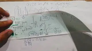 CVS physiology 22. voltage and time calibration of ECG paper, ECG basics, EKG basics