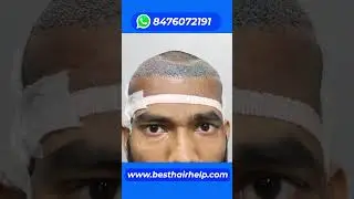 Hair Transplant Cost Of 2000 Grafts 🔥🔥🔥 #hairtransplantcost