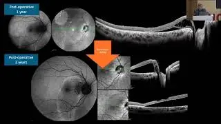 AIOCMTC4 2025 GP20 T Dr Rajpal Optic Disc Pit