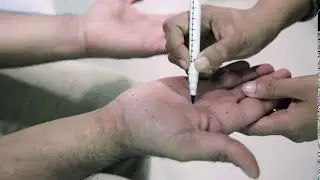 SWEATY HANDS | HYPERHIDROSIS | DR RASYA DIXIT | SKIN CARE TIPS