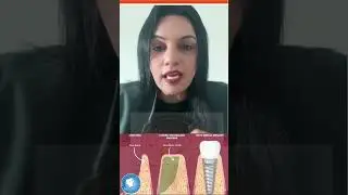 Implant vs Bridge? BEST Single Tooth Replacement Explained! | Dr. Kiran favad | Dentist Karachi