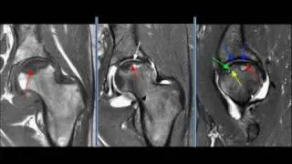 MRI Hip Case 02