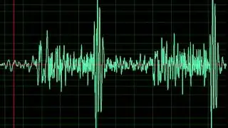 Mitral Regurgitation Tricuspid Regurgitation- normal speed