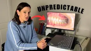 Watch Me Expand an Upper Arch to Solve Lower Crowding