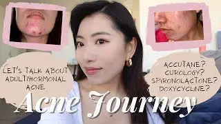 Acne JourneyㅣHow I cleared my skinㅣHormonal & Adult AcneㅣAccutane? Spironolactone? Doxycycline?