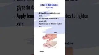 Glow up series, DARK KNUCKLES! #darkpatches #hyperpigmentationremove #hyperpigmentationtreatment