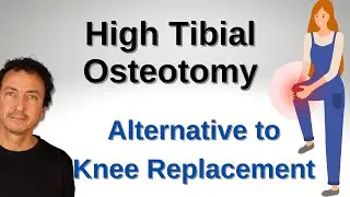 Is Knee Replacement the Only Option? Exploring High Tibial Osteotomy