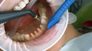 Variolink Esthetic/Monobond Etch & Prime - Assemblage d'une couronne réalisée en IPS e.max Press