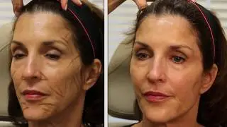 Sculptra
