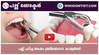 പല്ല് പറിച്ച ശേഷം  ശ്രദ്ധിക്കേണ്ട കാര്യങ്ങൾ/Things to look out for after Tooth Extraction