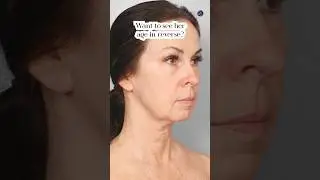 Natural Results| Neck and Facelift 3 Months Post-Op| Before and After