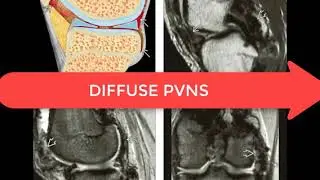22 Pigmented villonodular synovitis (PVNS)